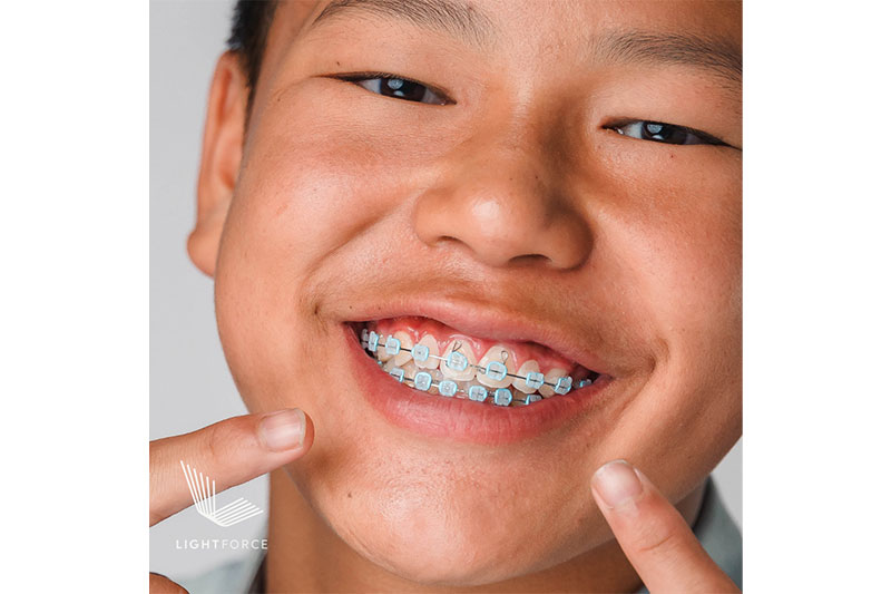 Lightforce Clear Braces in Garden Grove